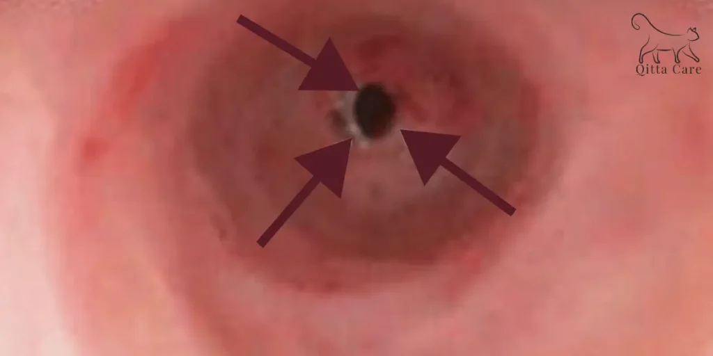 تضيق القولون